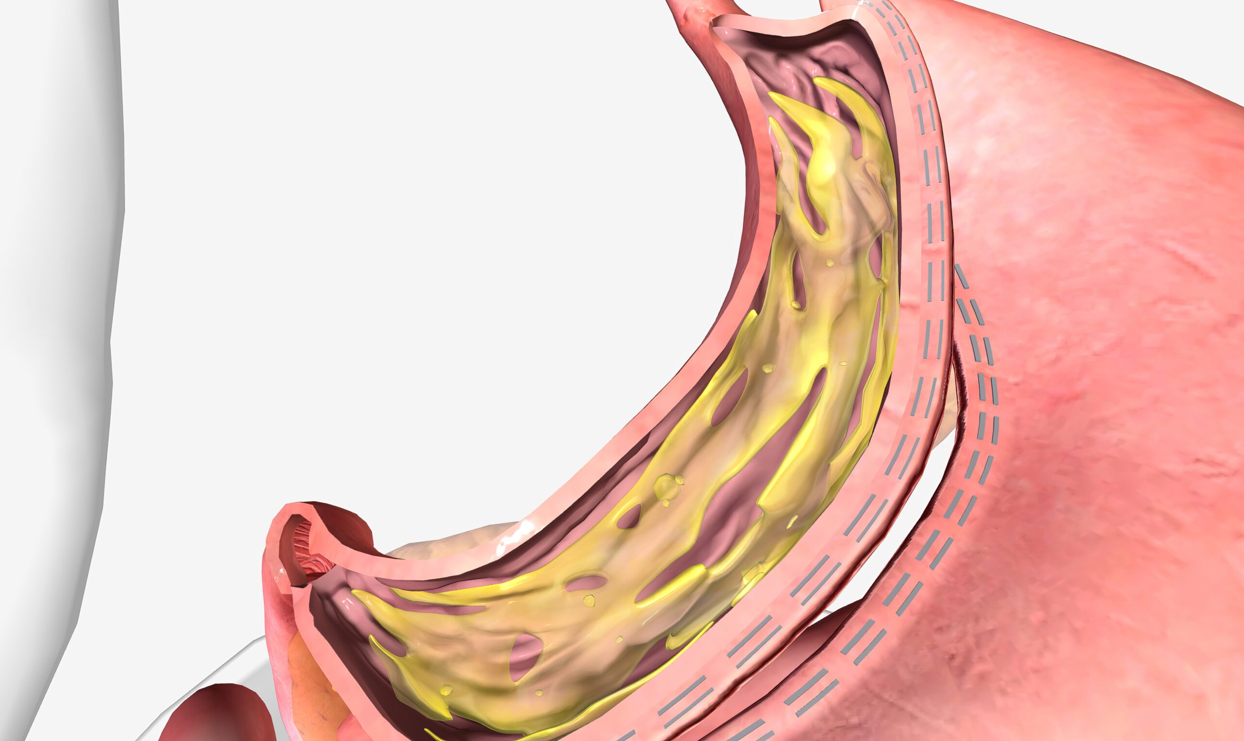 新加坡切胃手术