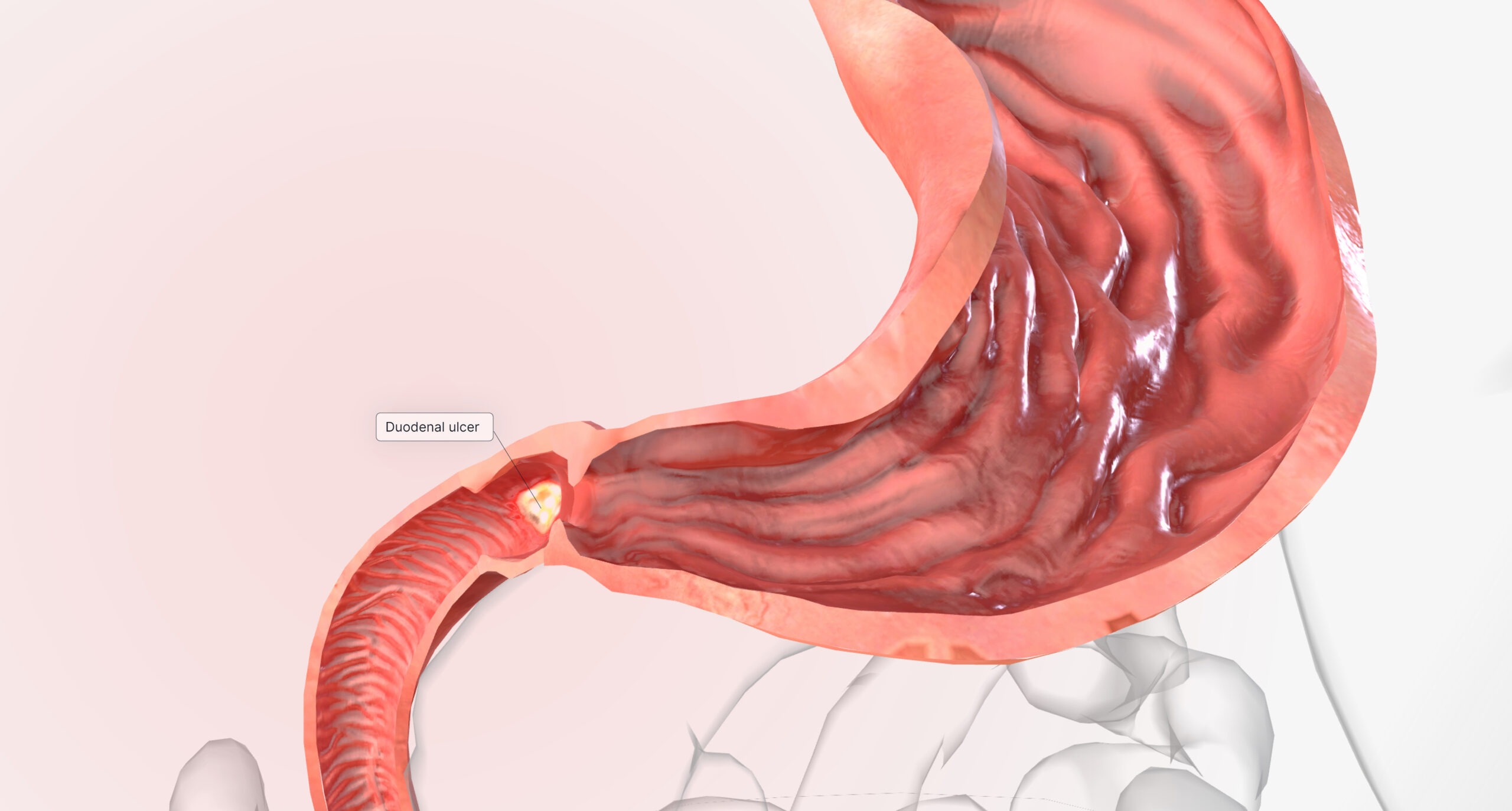 新加坡胃溃疡手术